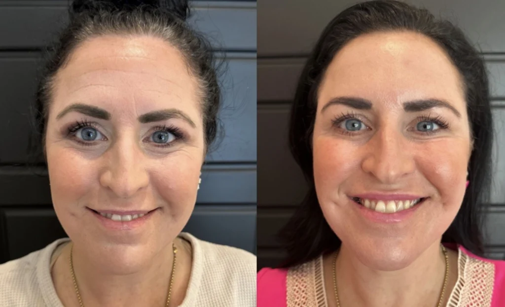 Before and after photo by Hailey Fontana of Fort Worth Medspa in Fort Worth, TX