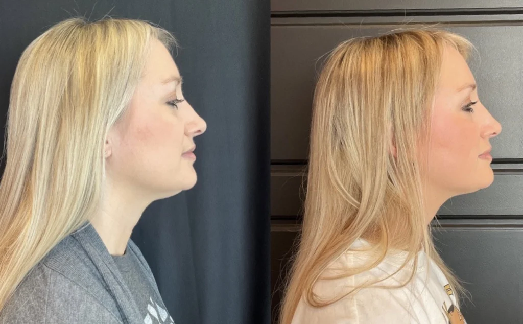 Before and after photo by Tamara Clark of Fort Worth Medspa in Fort Worth, TX