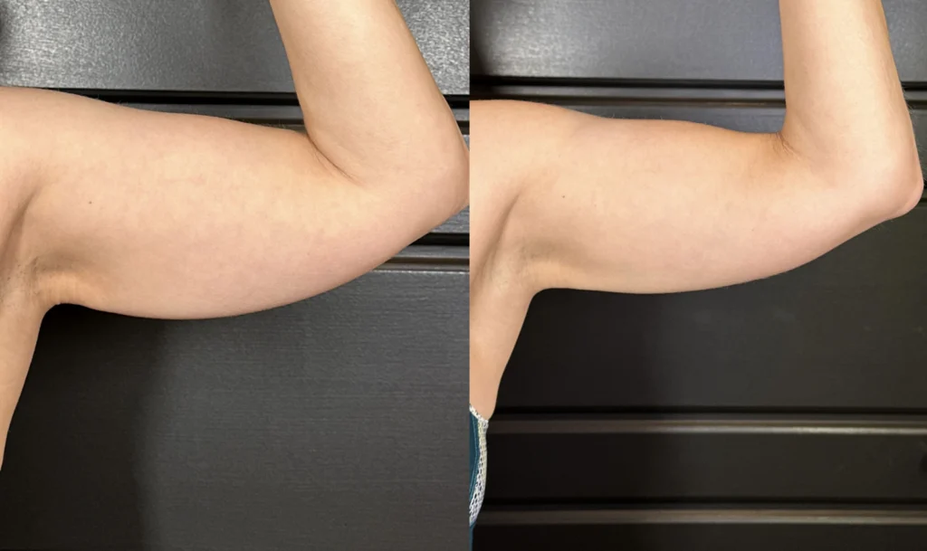 Before and after photo by Helaina Angeletos of Fort Worth Medspa in Fort Worth, TX