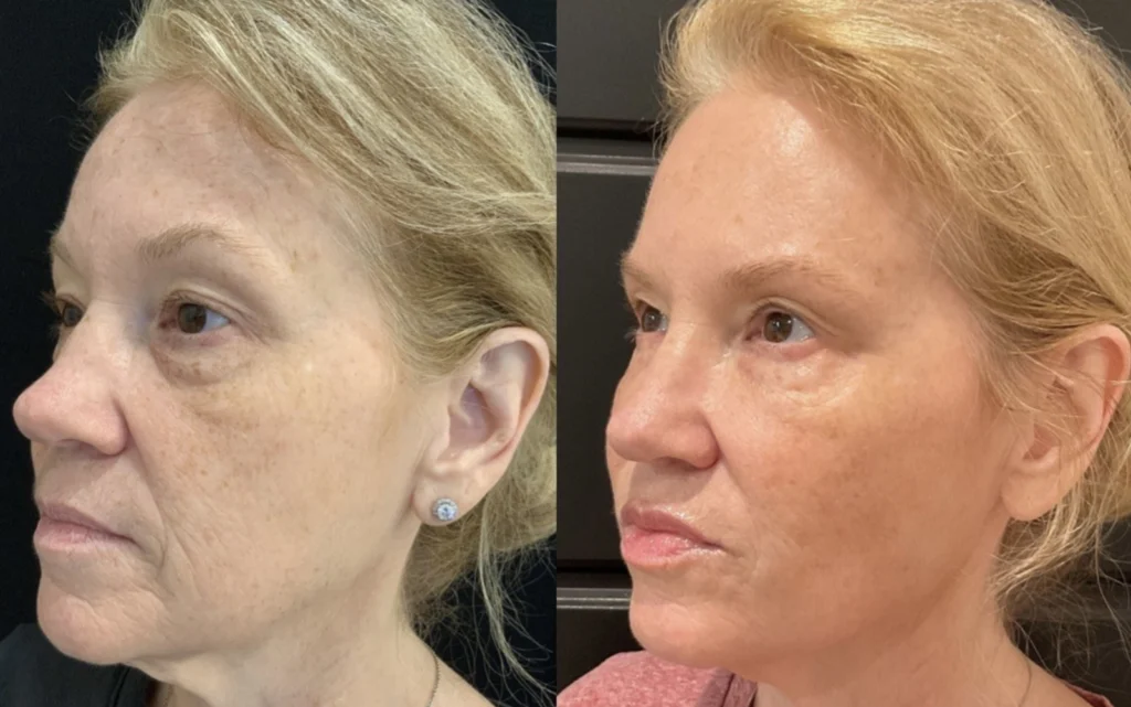 Before and after photo by Jessica Redden of Fort Worth Medspa in Fort Worth, TX