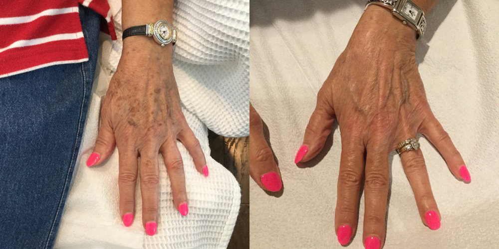 Laser Skin Rejuvenation before and after photo by Fort Worth Medspa in Fort Worth, TX