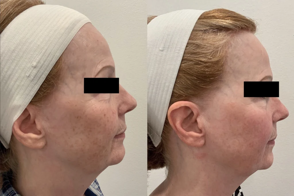 Before and after photo by Jana Kazazic of Fort Worth Medspa in Fort Worth, TX