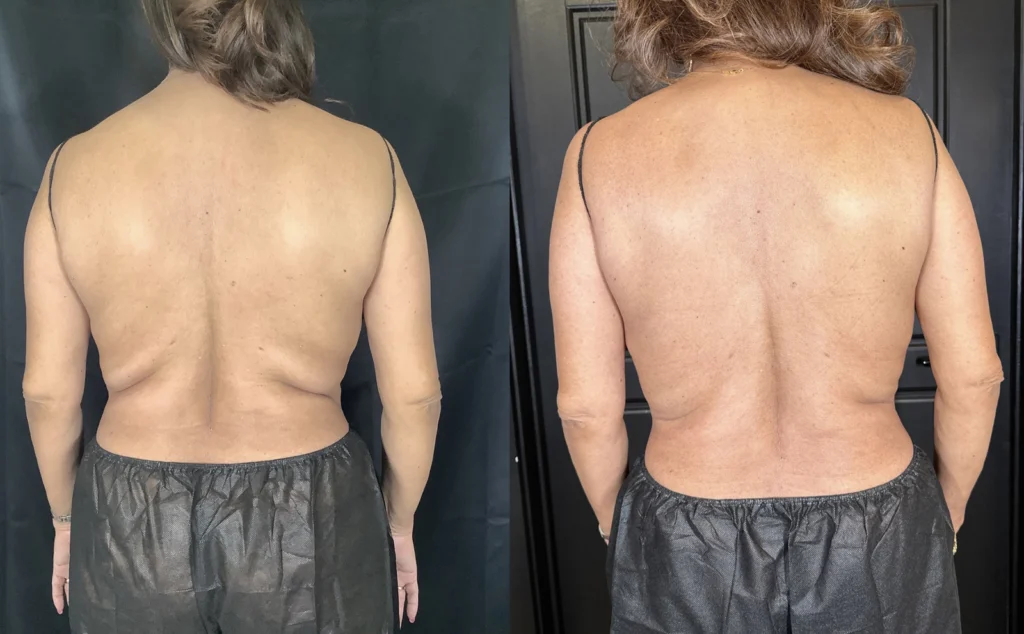 Before and after photo by Helaina Angeletos of Fort Worth Medspa in Fort Worth, TX