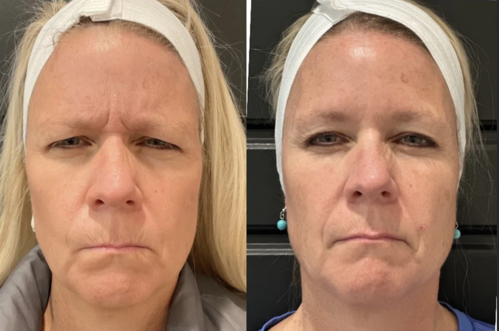 Before and after photo by Jessica Redden of Fort Worth Medspa in Fort Worth, TX