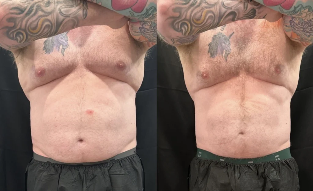 CoolSculpting before and after photo by Fort Worth Medspa in Fort Worth, TX