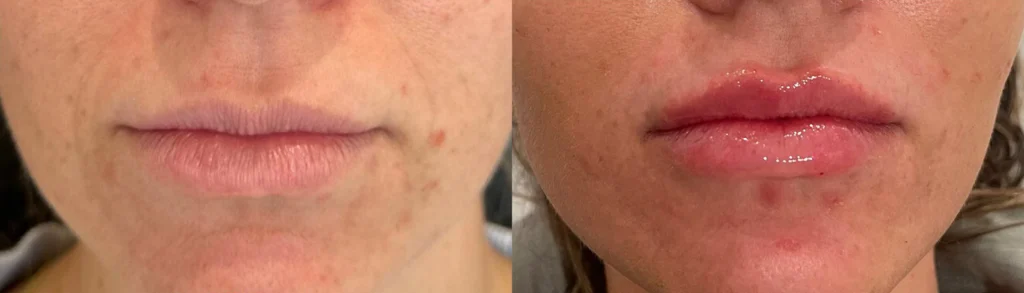 Juvederm Ultra before and after photo by Fort Worth Medspa in Fort Worth, TX